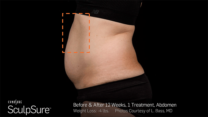 SculpSure before and after results showing significant fat reduction